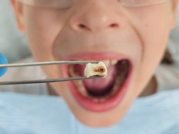 Emergency Dental Filling Replacement in KY